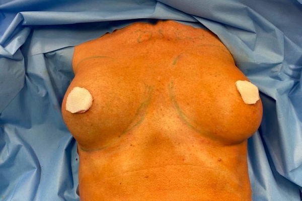 Brustform
