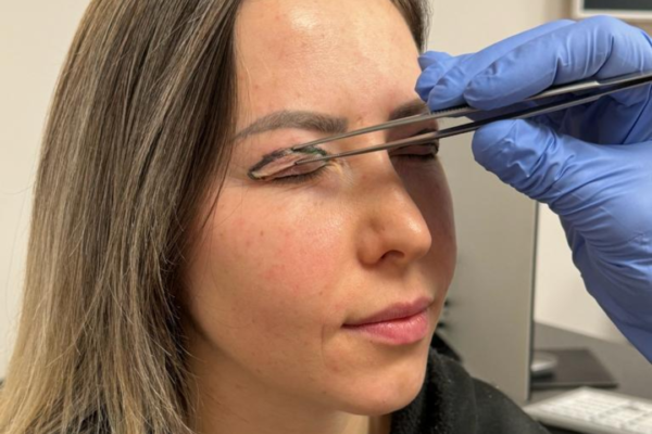Frau mit geschlossenen Augen und Markierungen zur Oberlidstraffung, Hand des Chirurgen mit Pinzette am geschlossenen Oberlid